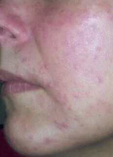 factor de transferencia acne