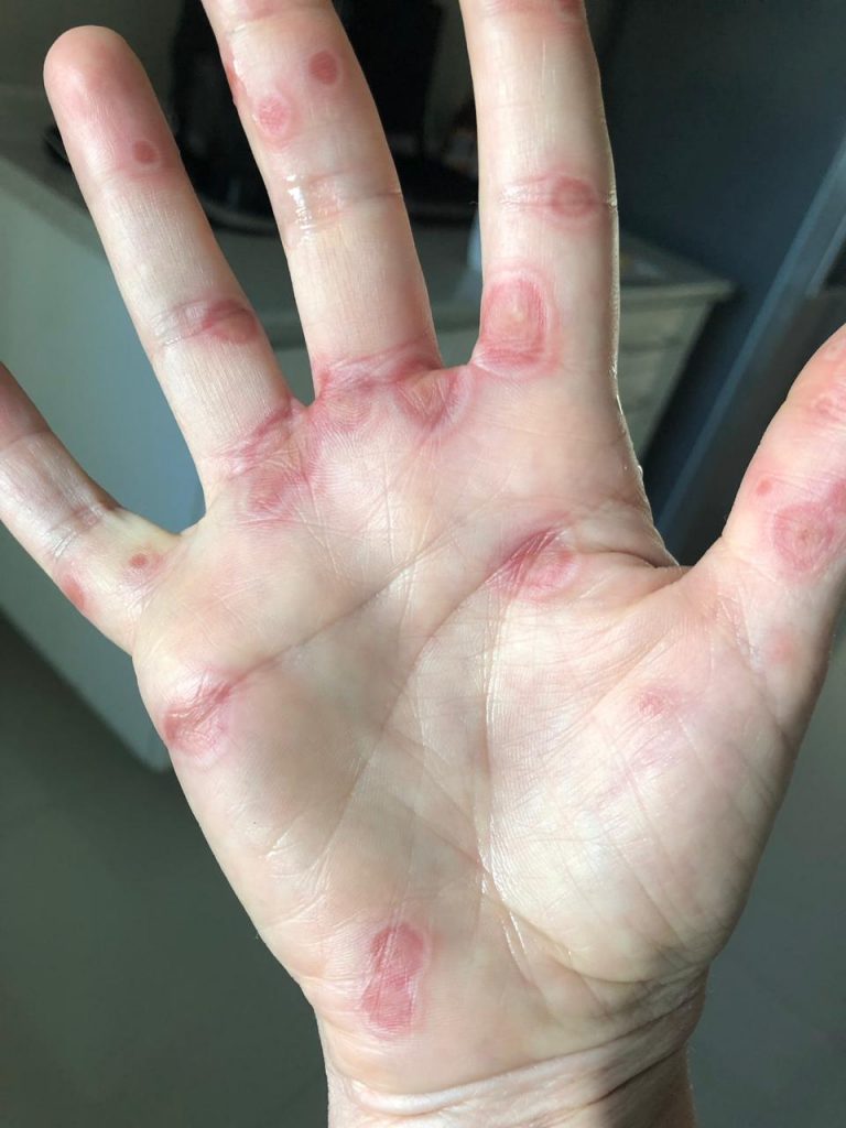 factor de transferencia herpes zoster