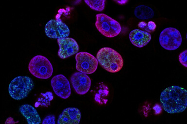 factor de transferencia cancer