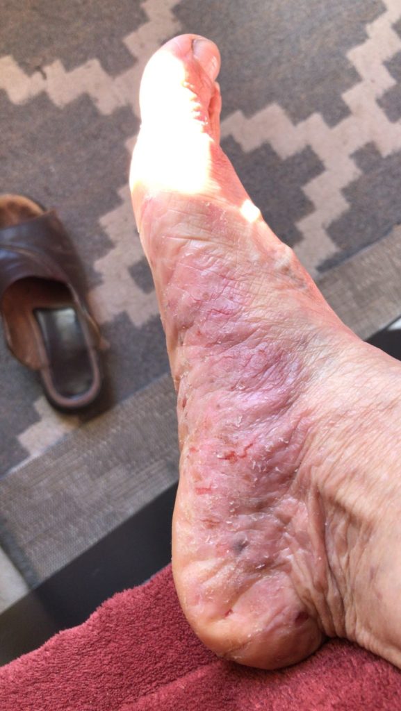factor de transferencia psoriasis