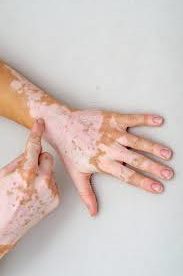factor de transferencia vitiligo